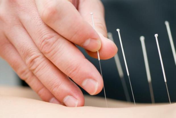 acupuncture-needles